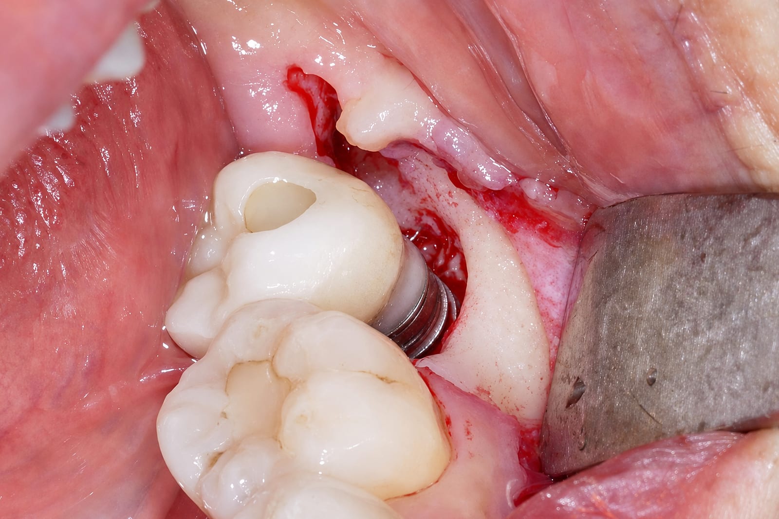The same posterior site after debridement with the NiTi Brush