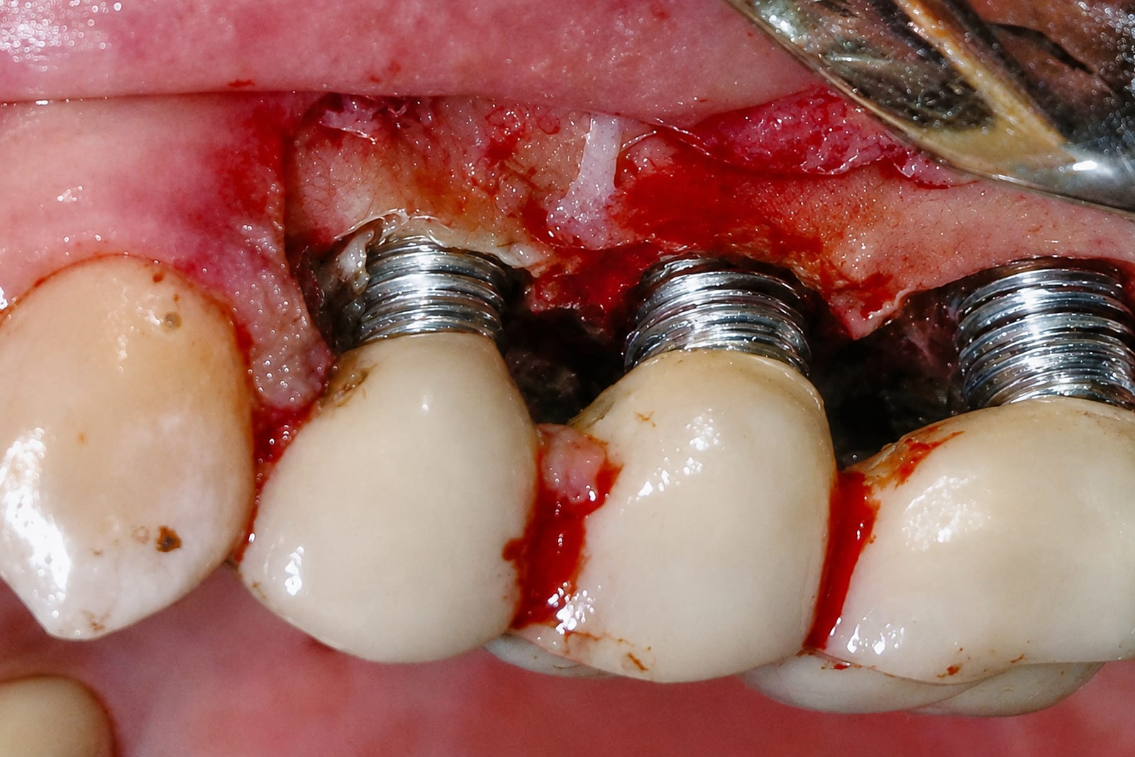 The same three implants after debridement with the NiTi Brush, threads bright and machined