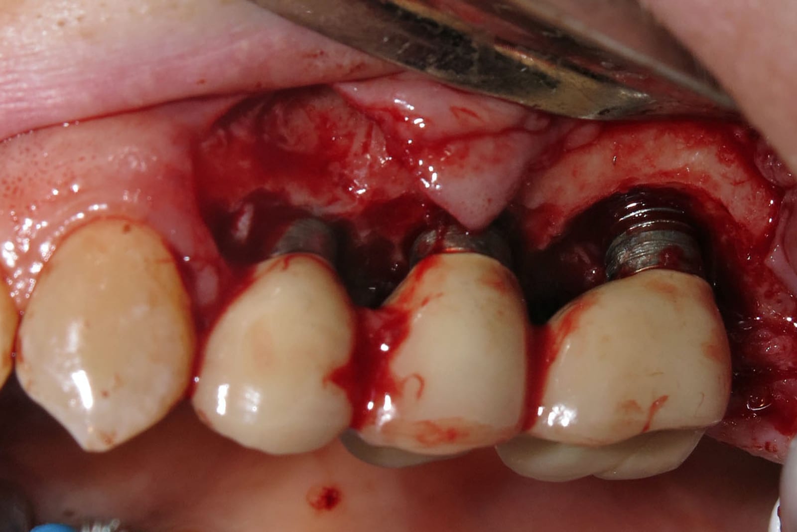 Three adjacent implants with contaminated, exposed threads before debridement