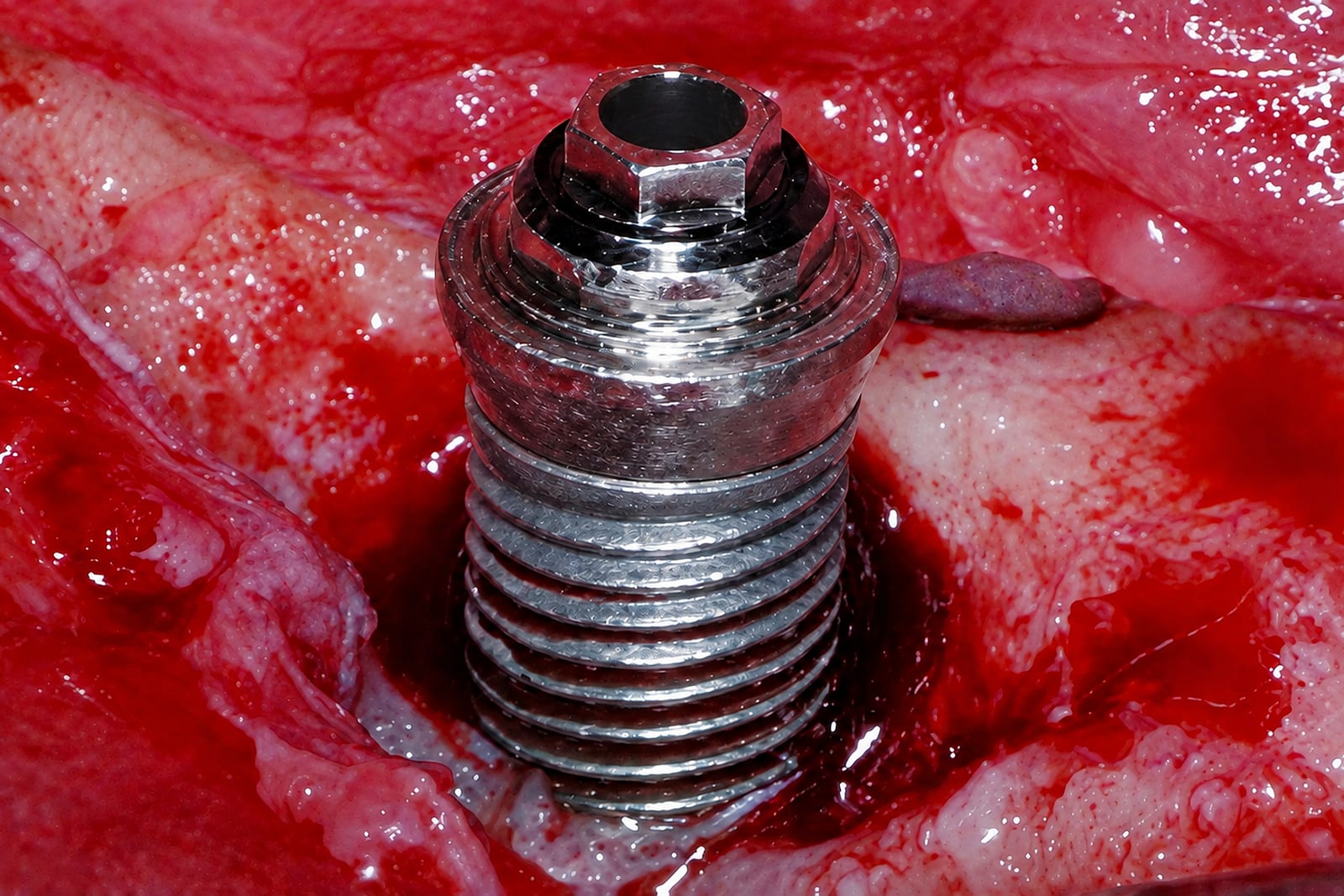 The same implant after mechanical debridement with a nickel-titanium brush