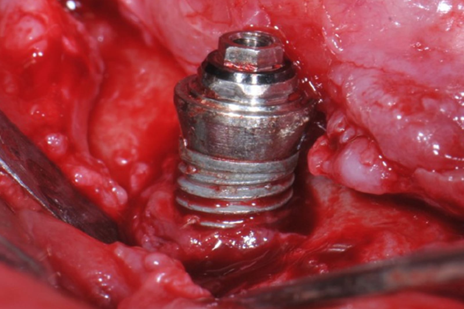Exposed implant threads with peri-implantitis before mechanical debridement