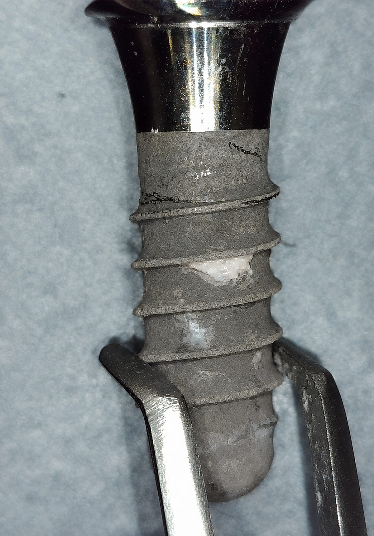 Removed implant A01 before debridement, threads coated with deposits