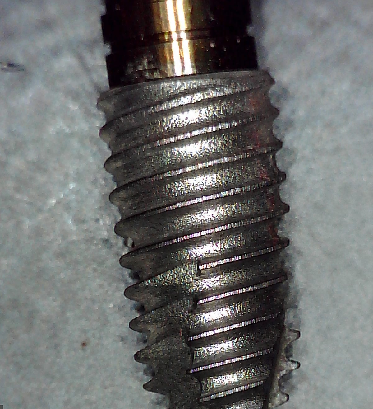 Removed implant A02 after debridement with the NiTi Brush