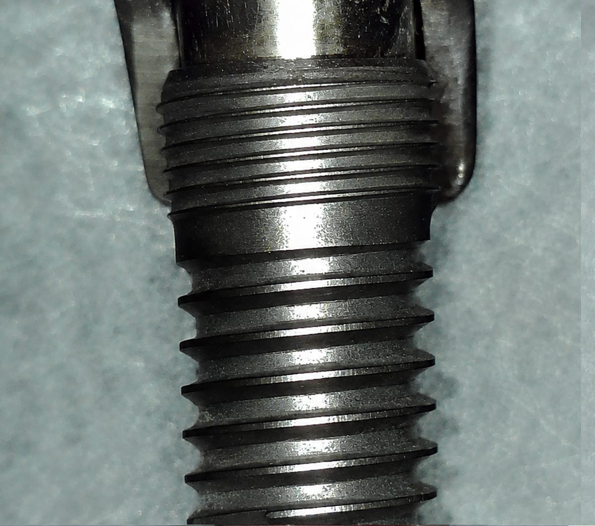 Removed implant A04 after debridement with the NiTi Brush