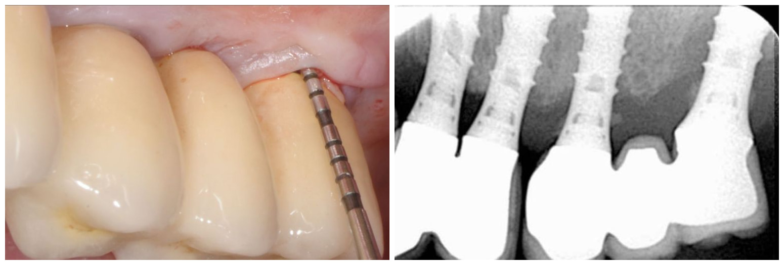 Probing the peri-implant pocket, with the corresponding radiograph