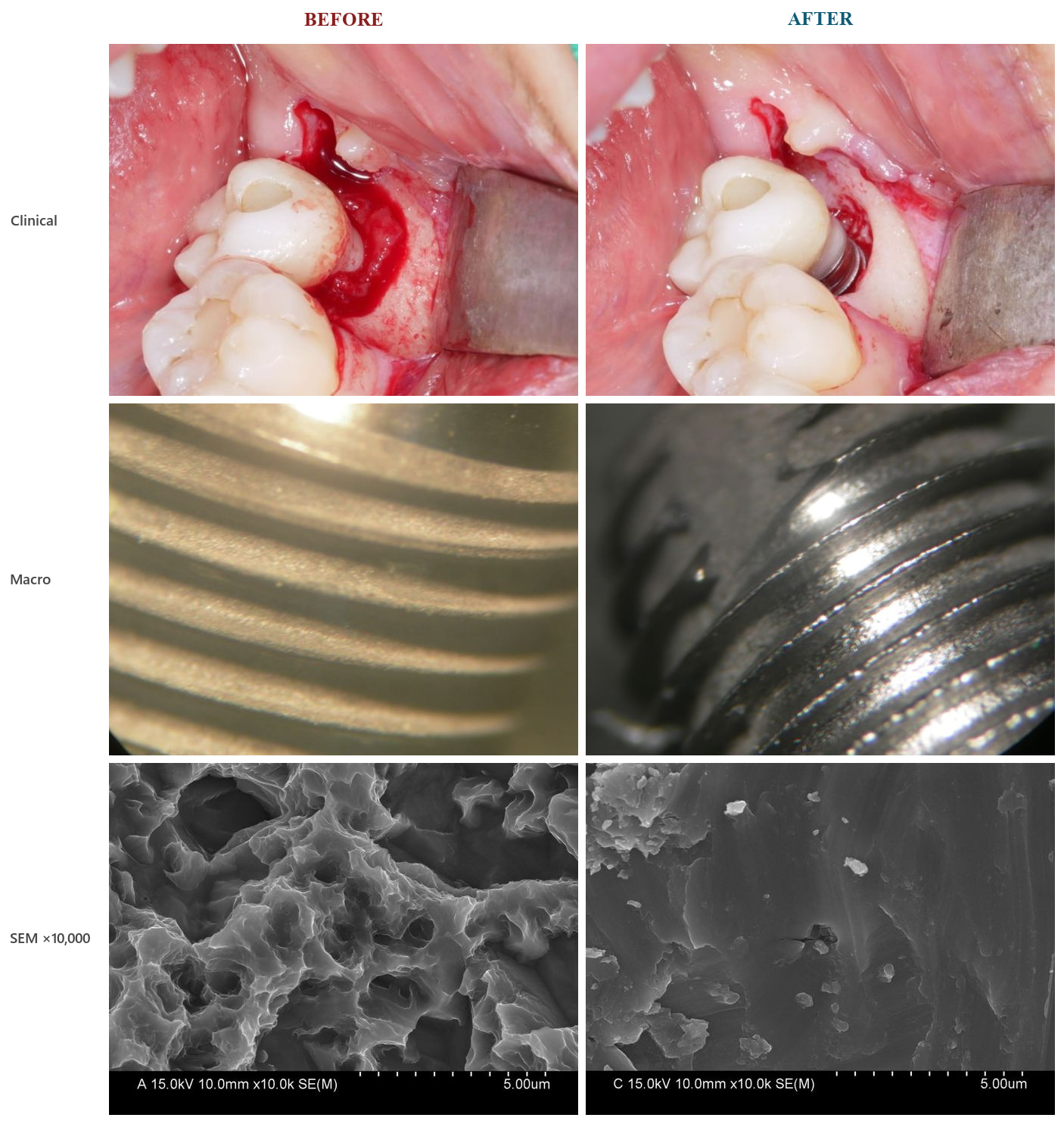 Implant surface before and after brushing — clinical, macro and SEM views