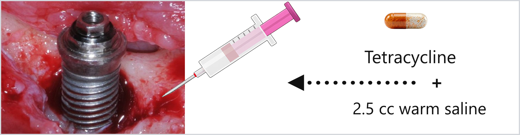 Applying the tetracycline solution to the debrided implant surface with a syringe