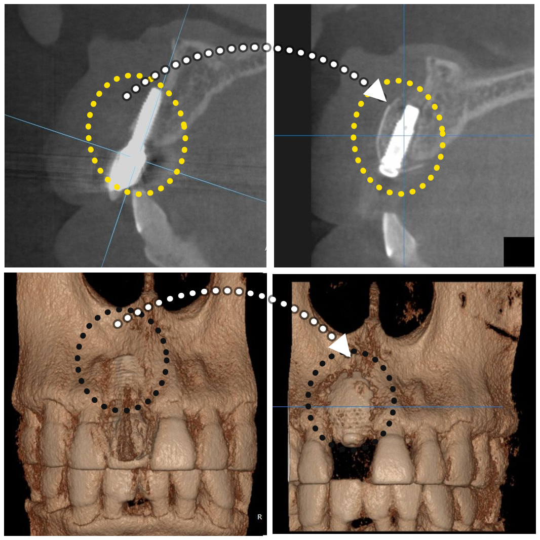 CBCT sagittal sections and 3D reconstructions of the same implant before and after treatment