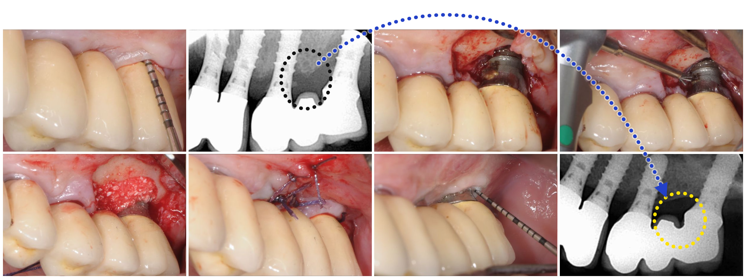 Complete case sequence — probing and radiograph at diagnosis, the exposed implant, debridement with the NiTi Brush, bone graft, suture, and probing and radiograph at follow-up