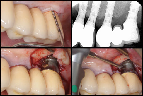 Clinical case by Dr. Mario Roccuzzo using NiTi Brush for peri-implantitis, view 1