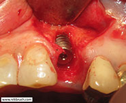 Guided bone regeneration step