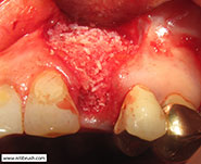 Guided bone regeneration step