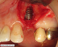 Guided bone regeneration step
