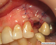 Guided bone regeneration step