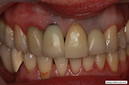 Peri-implantitis, clinical presentation