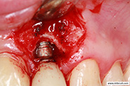 Debridement using the NiTi Brush with irrigation