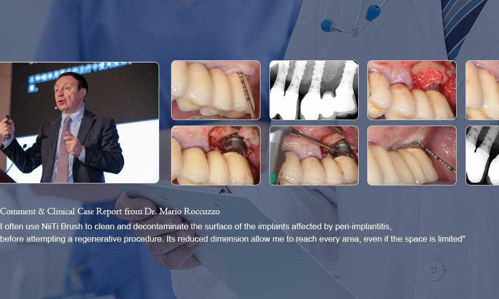 Comment and clinical case report from Dr. Mario Roccuzzo